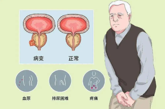 槲皮素对前列腺增生方面的作用