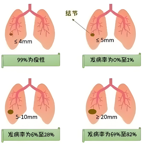 肺结节.png