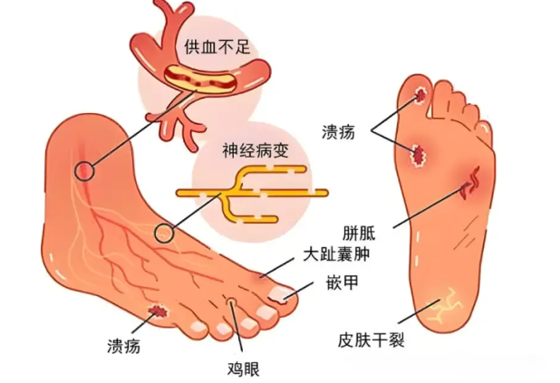 有没有什么办法让糖尿病足快速愈合