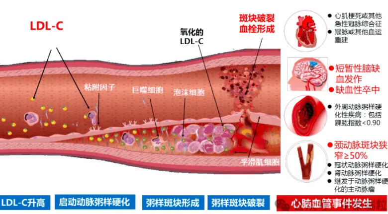 动脉硬化和动脉粥样硬化吃什么有完全消除