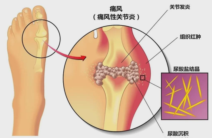 小小玉米须竟然能降尿酸治疗痛风？