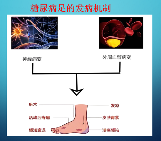 糖尿病足的发病机制1.png