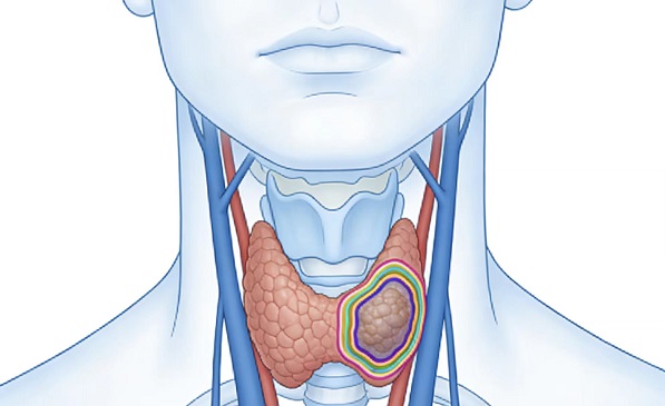甲状腺结节.jpg 甲状腺结节.jpg