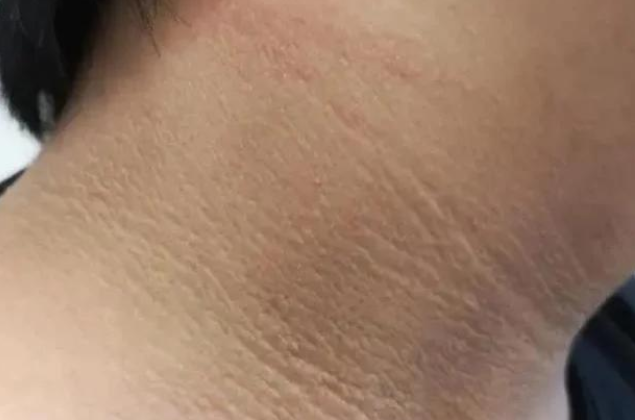 黑棘皮症的调理.png 黑棘皮症的调理.png