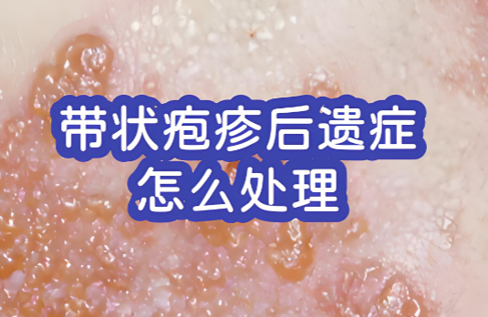 带状疱疹后遗症.png