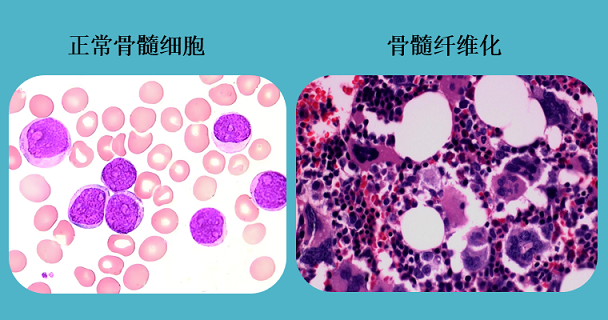 髓纤维化.png 髓纤维化.png