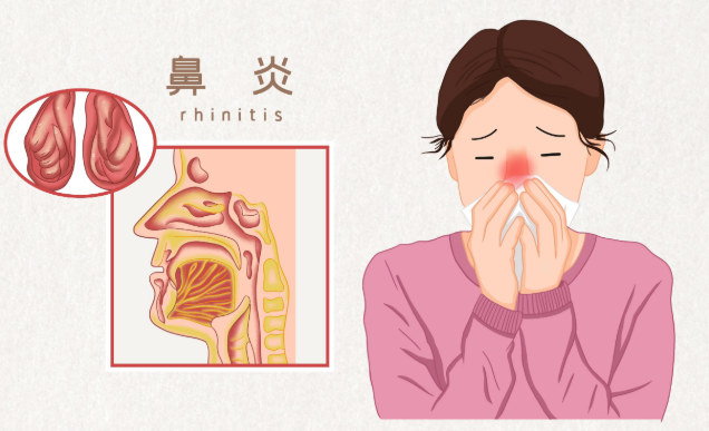 过敏性鼻炎怎么治疗.png