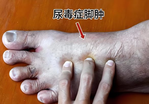 红宝胶囊与尿毒症.png 红宝胶囊与尿毒症.png
