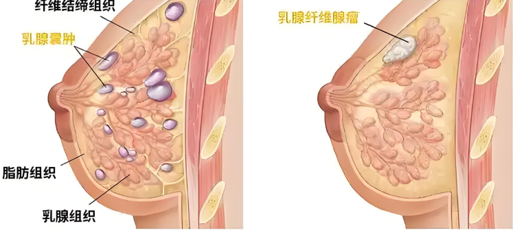 乳腺结节与增生.png 乳腺结节与增生.png