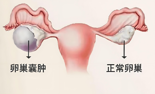 卵巢囊肿怎么治疗.png 卵巢囊肿怎么治疗.png